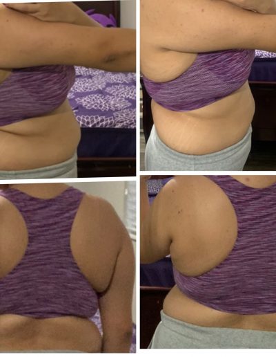 Before and after pic from front 5