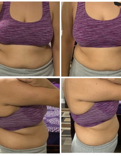 Before and after pic from front 4